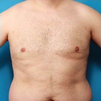 Gynäkomastie - Nachher