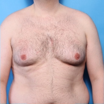 Gynäkomastie - Vorher