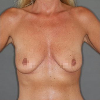 Brustvergrößerung - Vorher