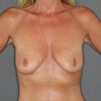 Brustvergrößerung - Vorher